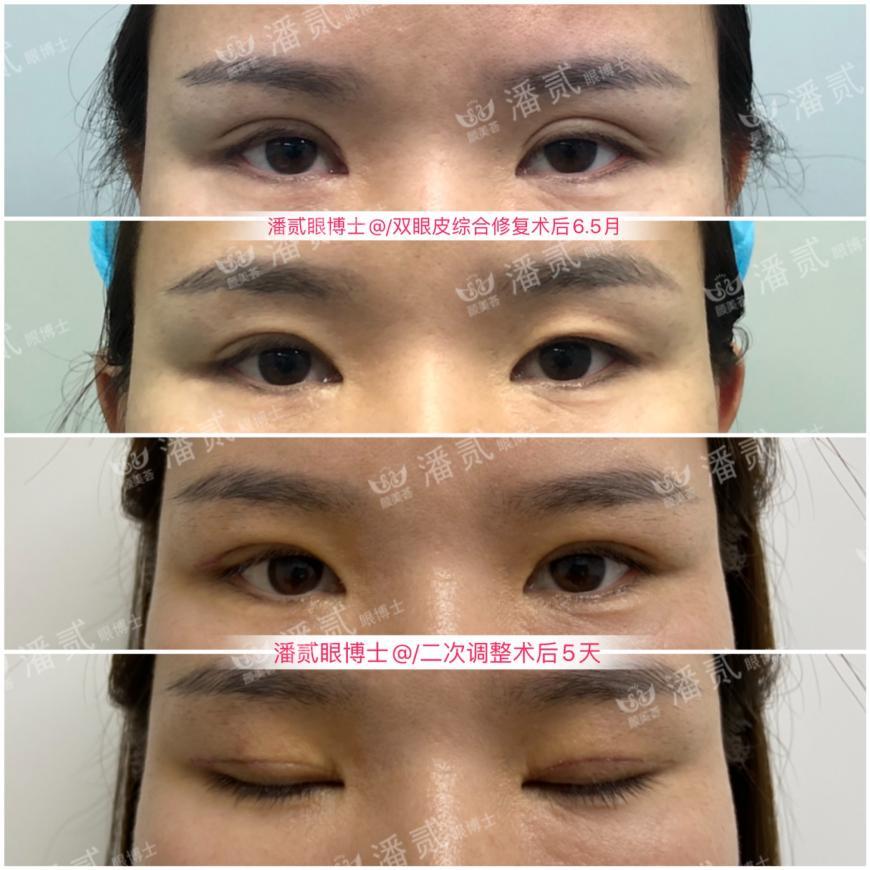 双眼皮太深显老怎么修复,双眼皮失败后修窄