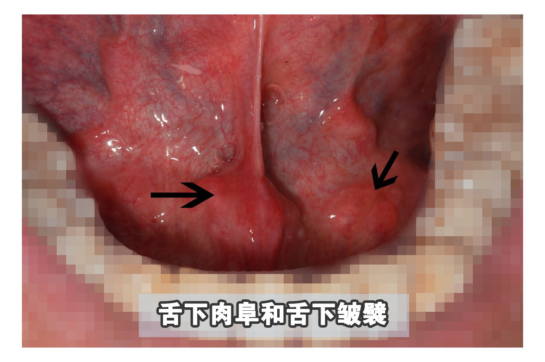 嘴里长了一个肉揪是怎么回事,嘴里长了肉疙瘩是癌症吗