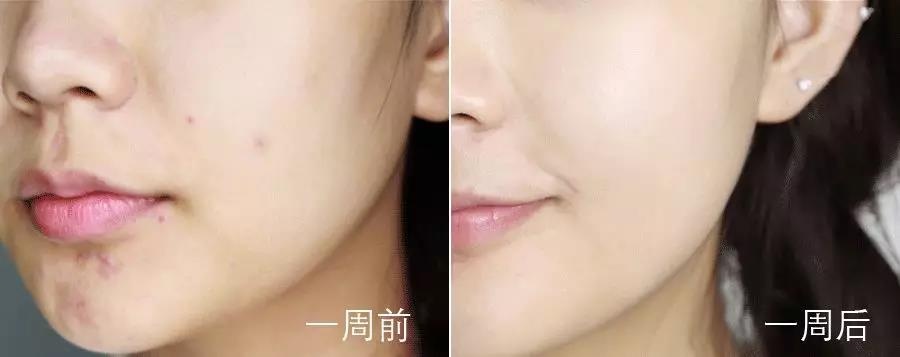 祛痘有效产品测评,祛痘产品老爸评测