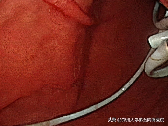 超声内镜下胰腺囊肿穿刺引流术,超声内镜下胰腺囊肿手术