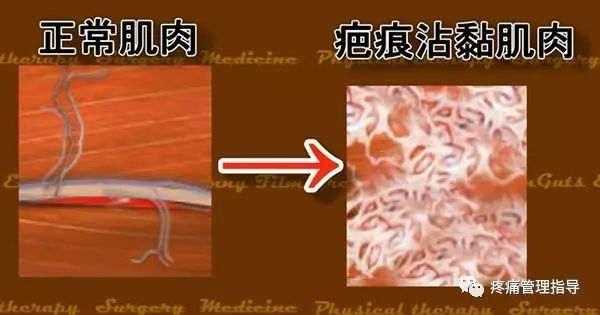 网球肘能自我恢复吗,网球肘病因的解剖学研究