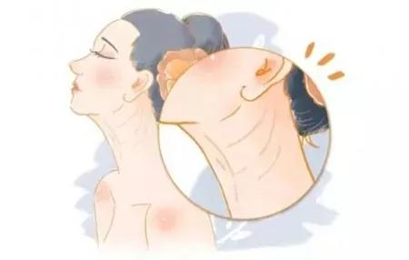 25岁就有颈纹了是怎么回事,30岁脖子颈纹好深怎么办