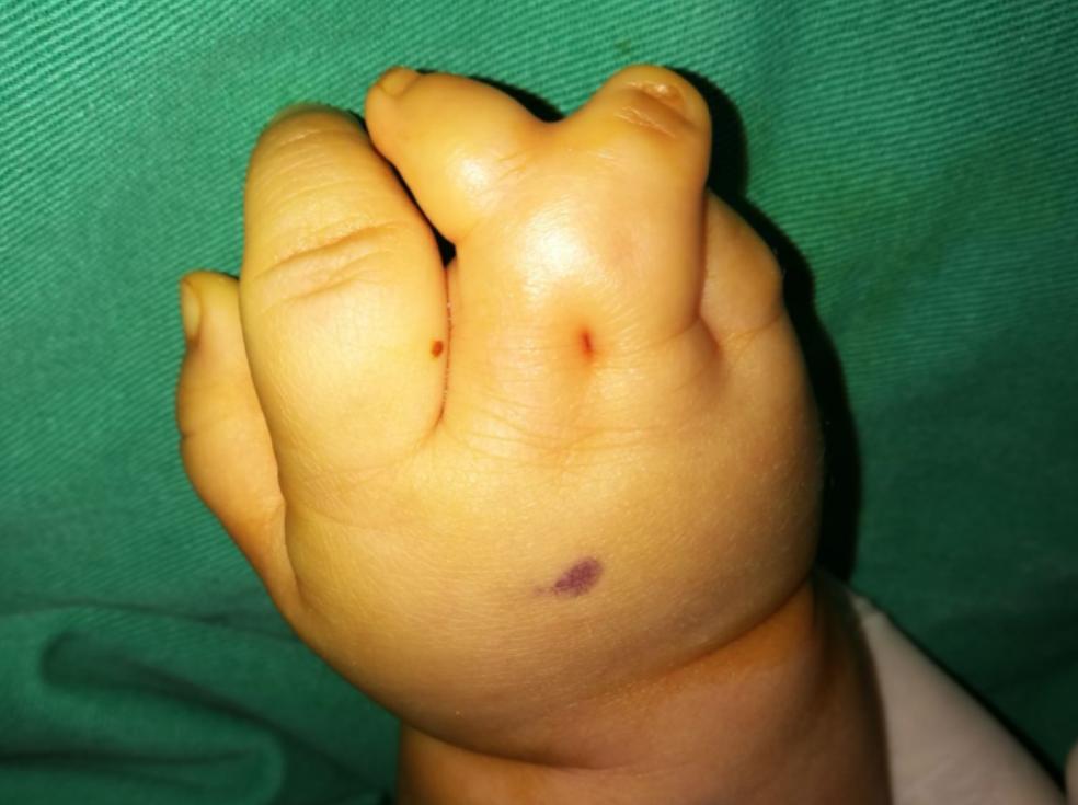 并指畸形免植皮案例,并指畸形