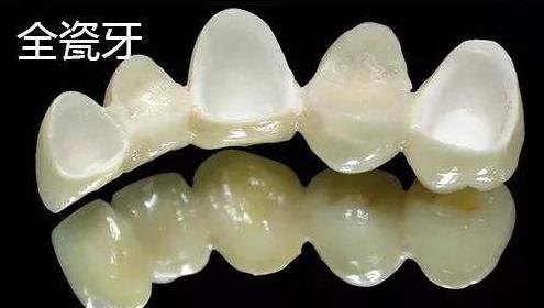 全瓷牙和烤瓷牙区别以及价格,烤瓷牙与全瓷牙有多大价格区别