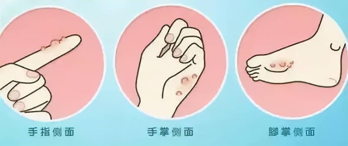 手上长脚气一样的水泡很痒怎么办,手上手臂起小水泡很痒是怎么回事