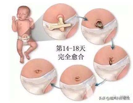 新生儿脐带未脱落前怎么穿尿不湿,新生儿脐带脱落前需要围腹围吗