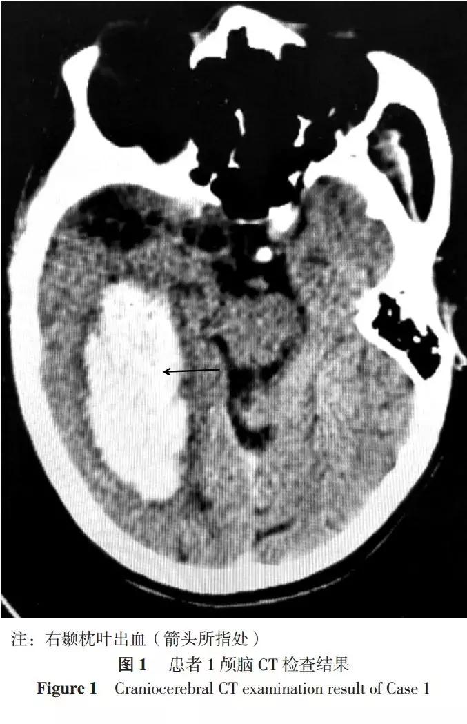 pci术后脑出血症状,脑出血案例分享