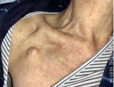 输液港的地方痒是怎么回事,输液港有点红肿是怎么回事