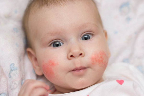 婴儿湿疹的原因及处理方法,婴儿湿疹的正确处理方法