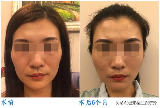 面部五层提升可以维持多久,做完面部提升三件套