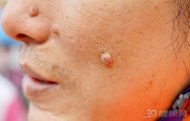 痣化脓出血了是不是癌变了,黑色素痣是否都会发展到癌