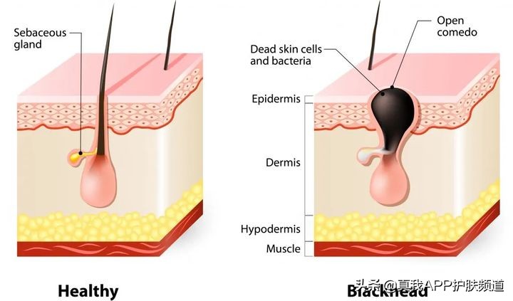 顽固黑头怎么去除最有效,变美小知识黑头怎么去掉