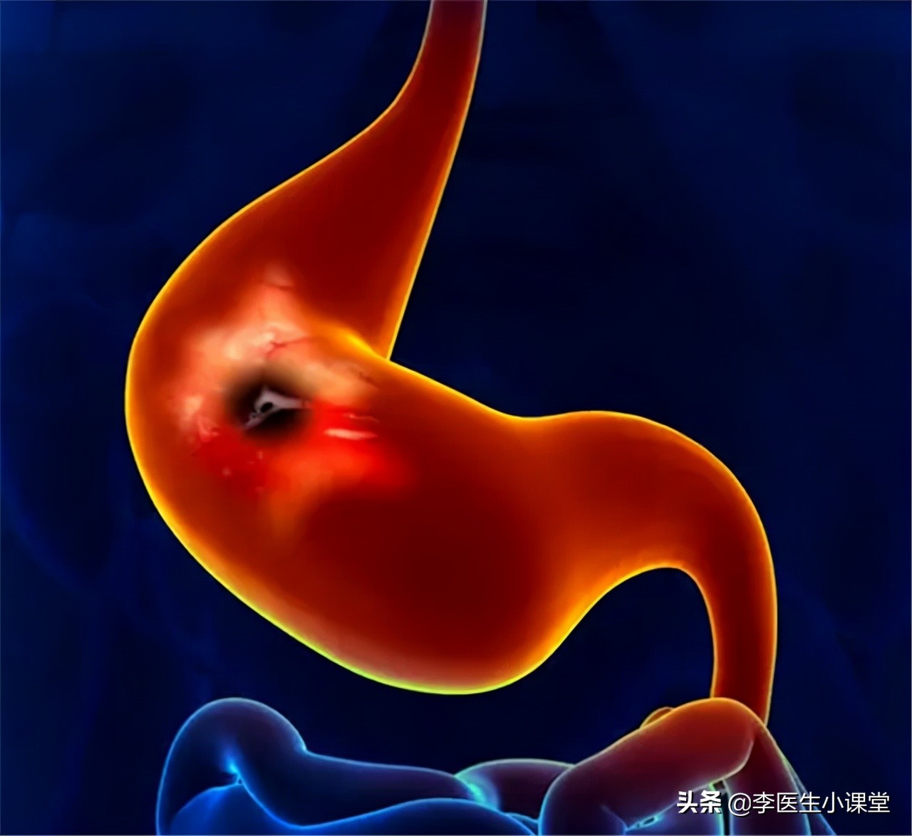 胃病幽门螺杆菌能彻底治疗吗,胃病幽门螺杆菌治疗