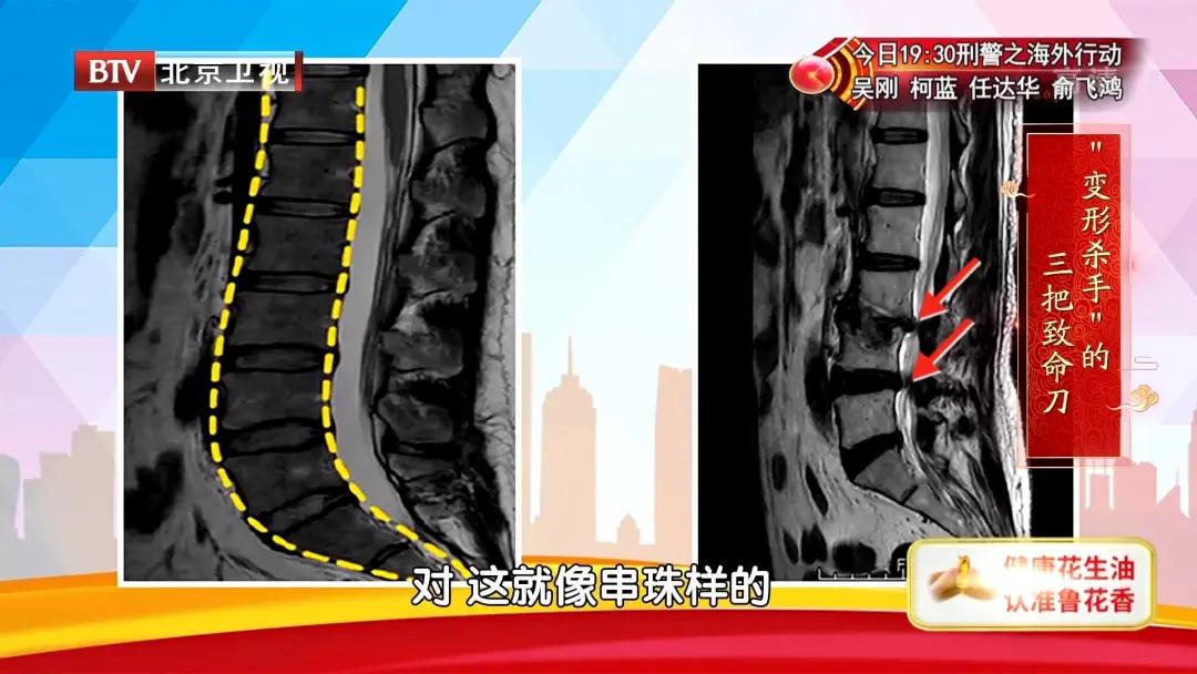 腰椎其中一节变形最好的治疗方法,腰椎轻度变形怎么治