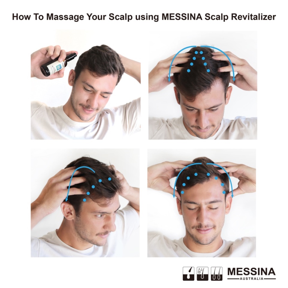 脱发脱成灭霸,我加入了妇愁者联盟!澳洲messina带你找回自信