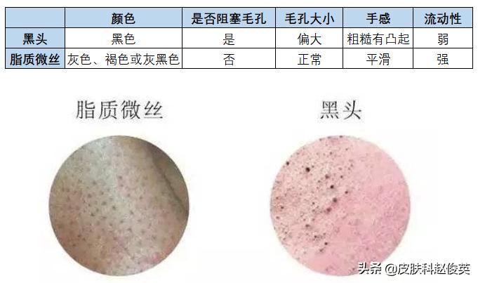 黑头和脂质微丝的区别,黑头里有白色的东西是脂质微丝吗