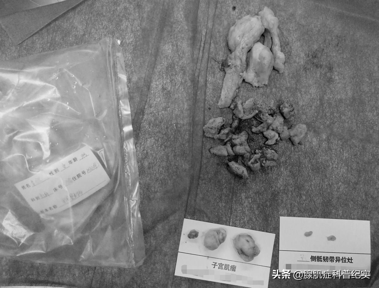 消融手术会导致月经排不出来吗,做消融术得打停经针吗