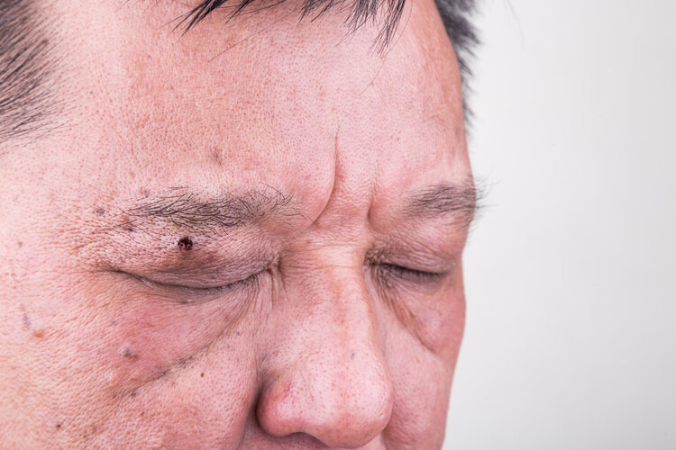 头上的痣20多年了会变癌吗,从小就有的痣会变成基底细胞癌吗