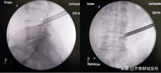 聊城腰间盘突出专科医院,聊城市人民医院腰椎管狭窄