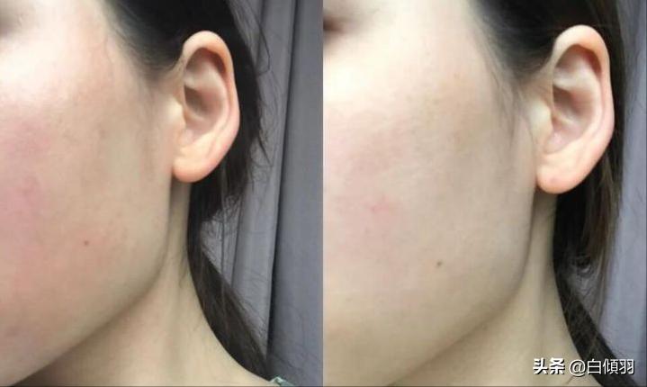 高原红怎样可以暂时缓解,高原地区皮肤干燥怎么办