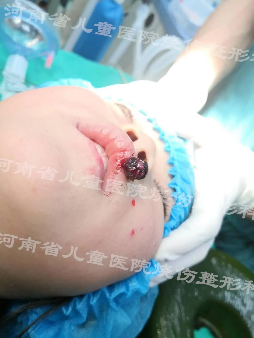 嘴唇上有红色的小血点出血止不住,嘴唇上小红点流血不止