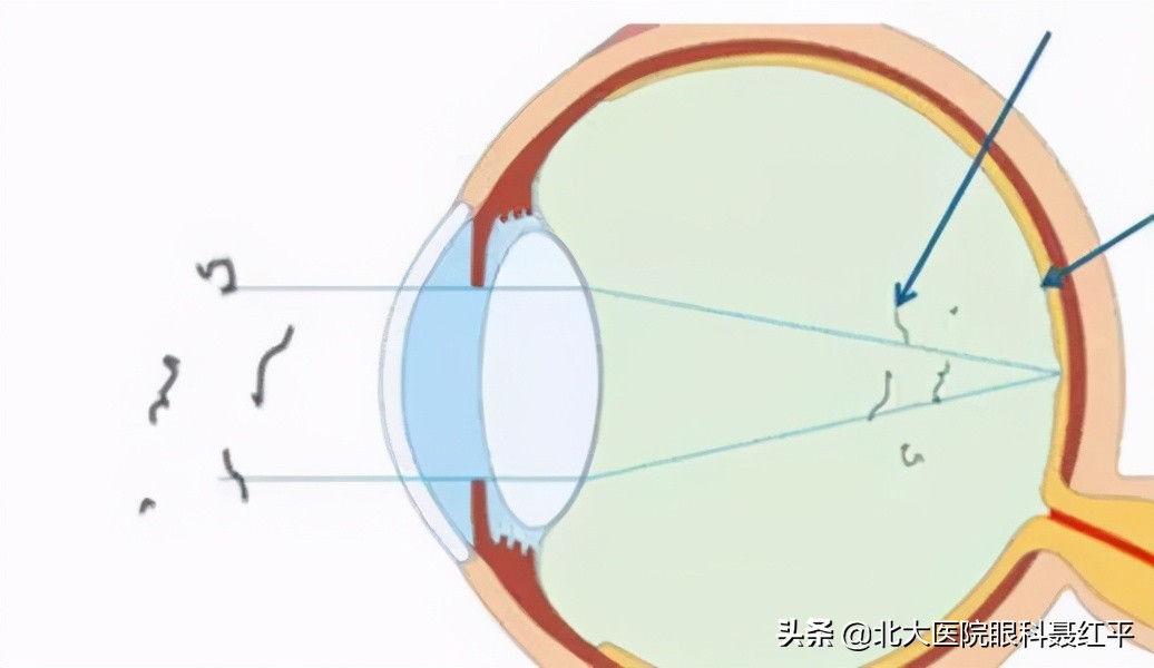 双眼玻璃体混浊后脱离什么意思,治疗玻璃体混浊的眼药水有哪些