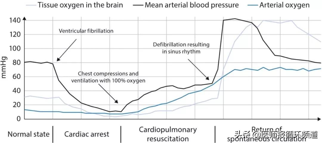 最佳的氧合指标及二氧化碳水平可增加冠状动脉血流，脑血流及氧输送！解读心脏骤停患者氧及二氧化碳理想目标