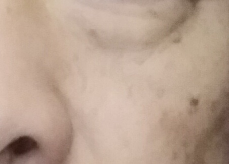 油溅到脸上有黑斑多久消失图片,40多岁脸上起黑斑是怎么回事