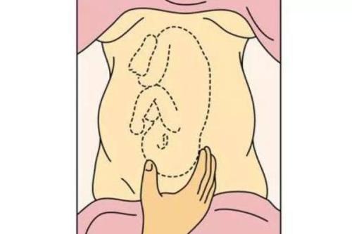 臀位有多大概率可以顺产,臀位能顺产的几率