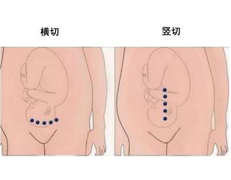 剖腹产让人感动的话,剖腹产出来感人时刻