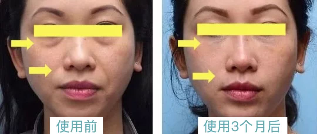 做了微整之后的感悟,微整经验