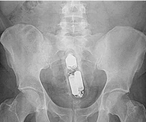 不作死就不会死，看看这些被人类搞进身体里的异物