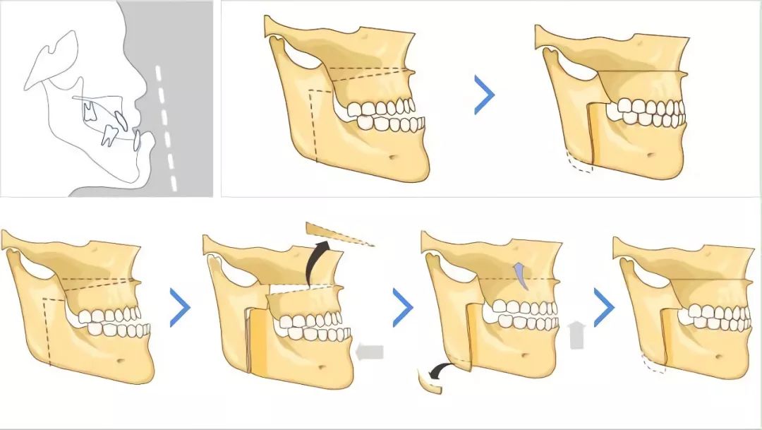 地包天科普主题,孩子地包天的治疗方法