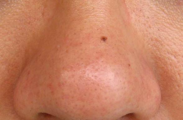 娇韵诗祛黑头和科颜氏祛黑头,怎么去黑头小窍门8招简单有效