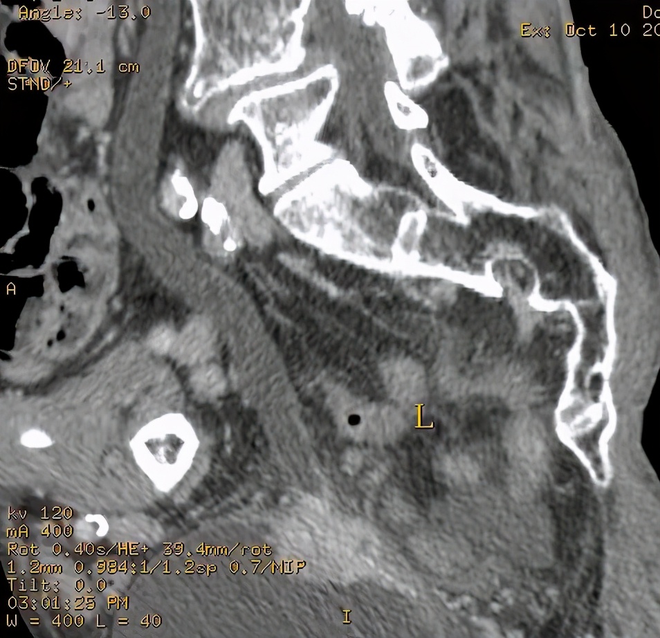 尿路造影输尿管间断显影,静脉尿路造影和排泄性尿路造影