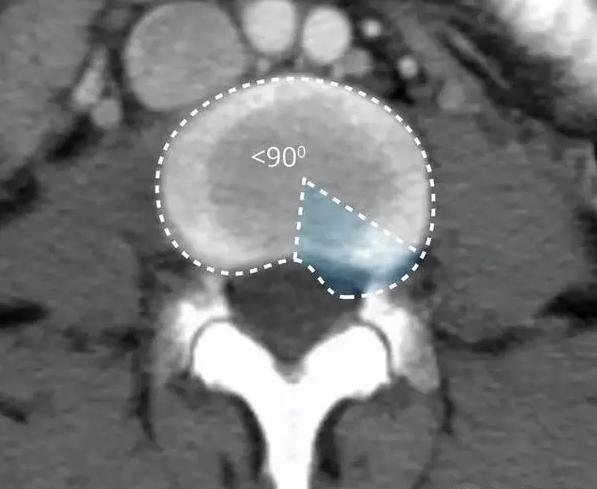 腰椎间盘的膨出和突出有什么区别,腰椎间盘突出膨出骨质增生怎么治