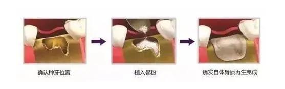 牙槽骨过度发育老了会怎么办,中国年轻人牙槽骨萎缩严重