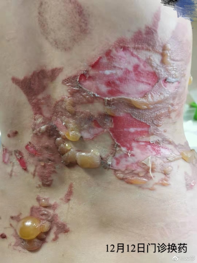 拔火罐被烧伤的明星,拔火罐明星烧伤