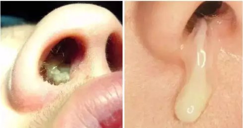 宝宝流鼻涕有什么好的解决方法吗,宝宝流鼻涕有什么好的解决办法