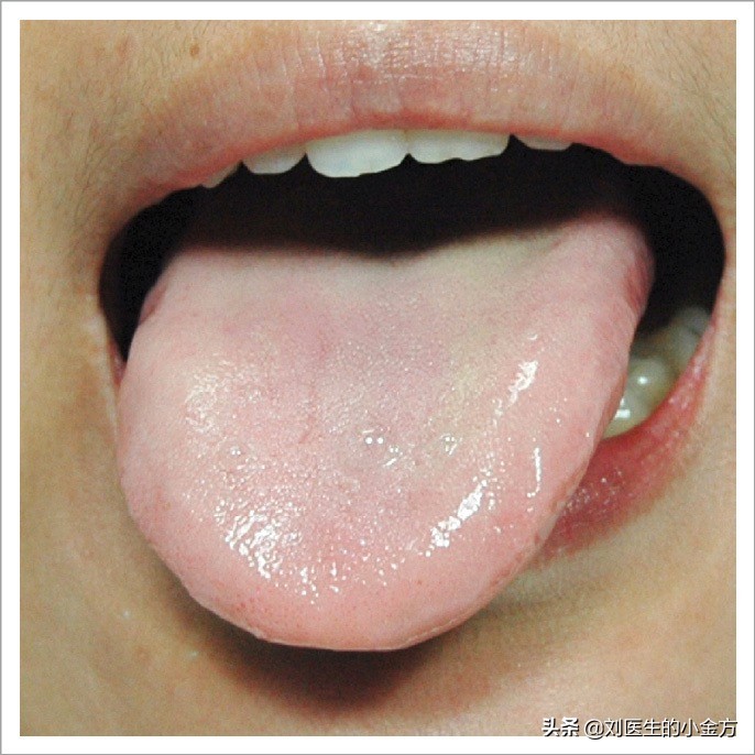舌象图解大全中医舌诊,最全中医舌诊图谱来了