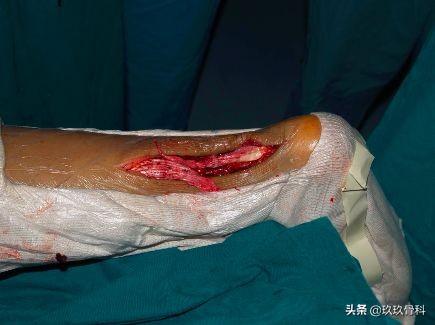 陈旧性踝关节损伤的治疗,踝关节损伤现场处理视频