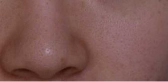 打败毛孔！下一个反孔精英就是你！