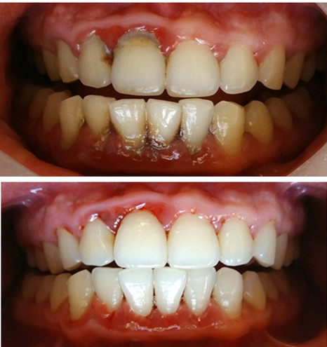 洗牙一般多久洗一次比较好知乎,洗牙多久洗一次好