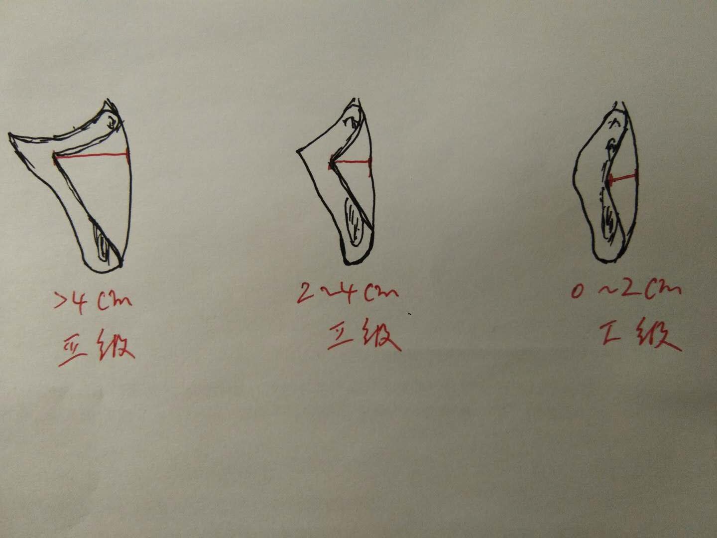 夏天到了，咱们来聊个羞羞的话题——小阴唇整形术