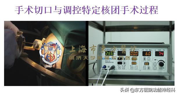 微创手术治疗精神病案例,手术治疗精神病的危害