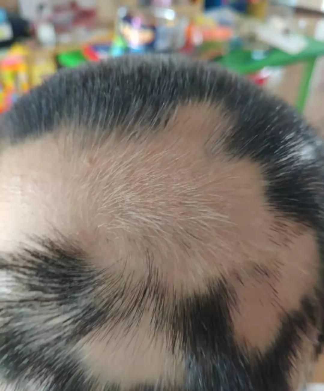 斑秃属于疑难杂症么,斑秃治疗中越来越严重怎么回事