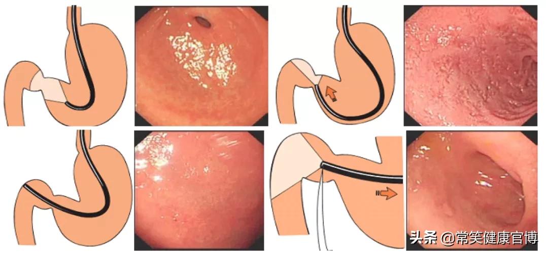 做过肠胃镜检查后饮食要注意事项,胃镜检查后要注意什么