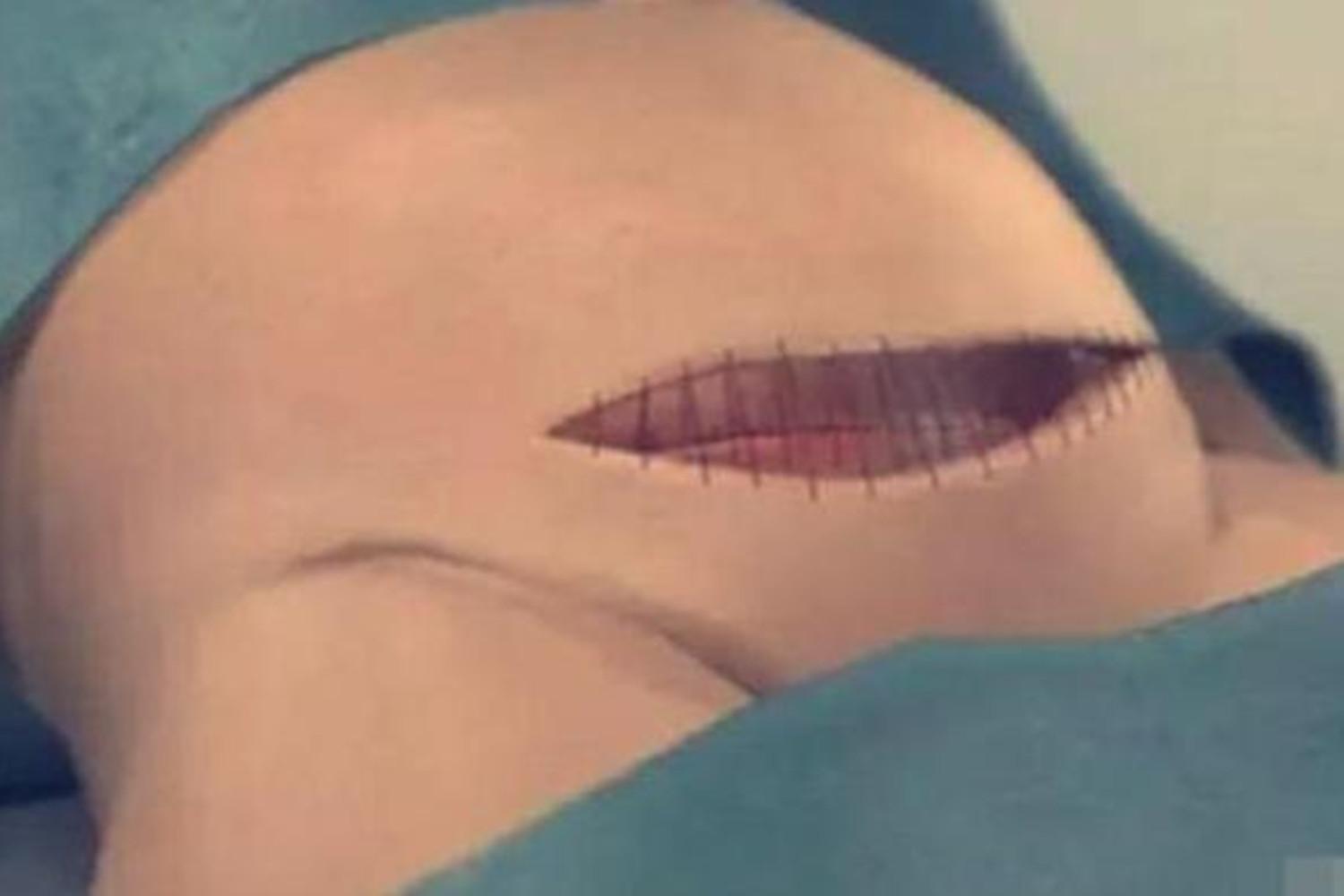 剖腹产只挨一刀,剖腹产都是挨一刀吗