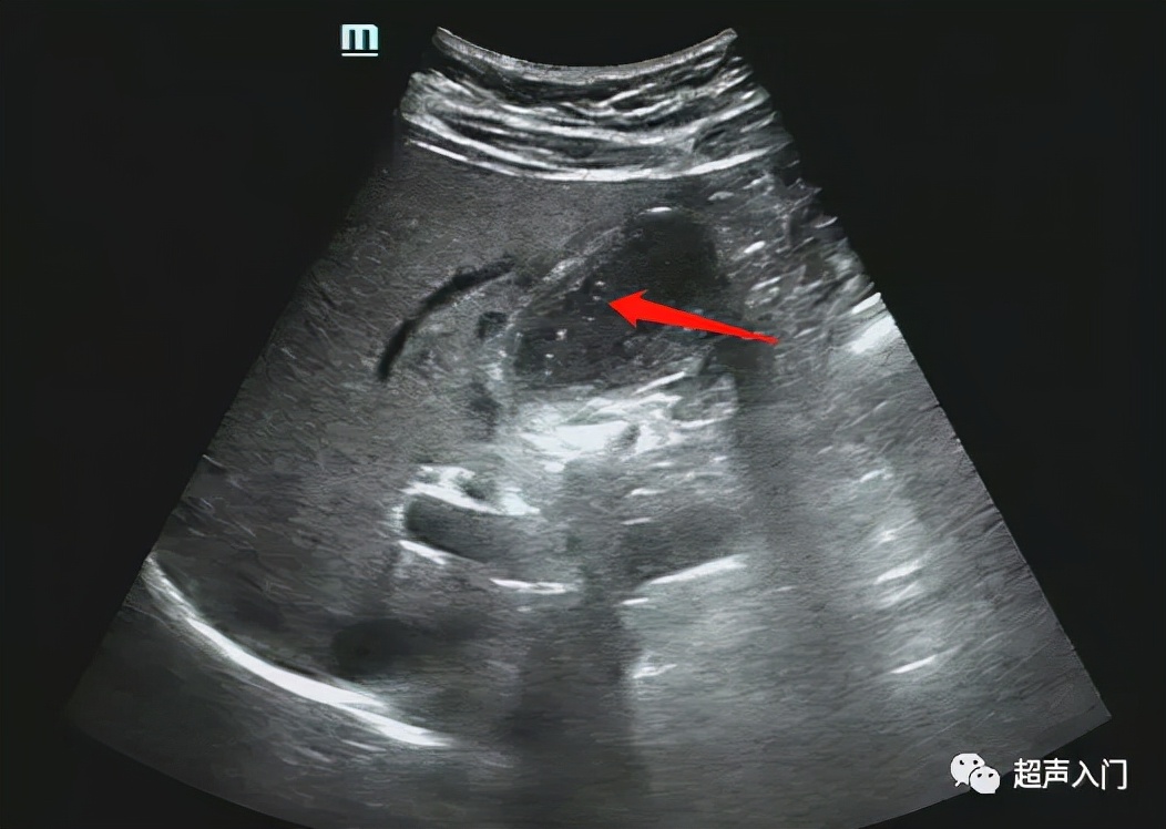 急性胆囊炎超声表现入门教学视频,急性胆囊炎超声诊断怎么写