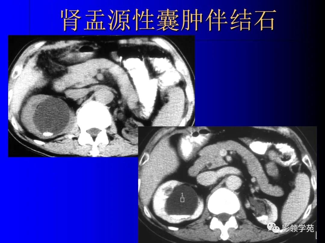 肾脏囊性肿块的影像学特点,肾脏典型病理图片及解析
